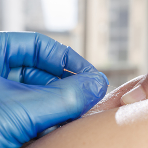 Dry needling close-up foto van twee handen die een naald in de huid van een patiënt prikken